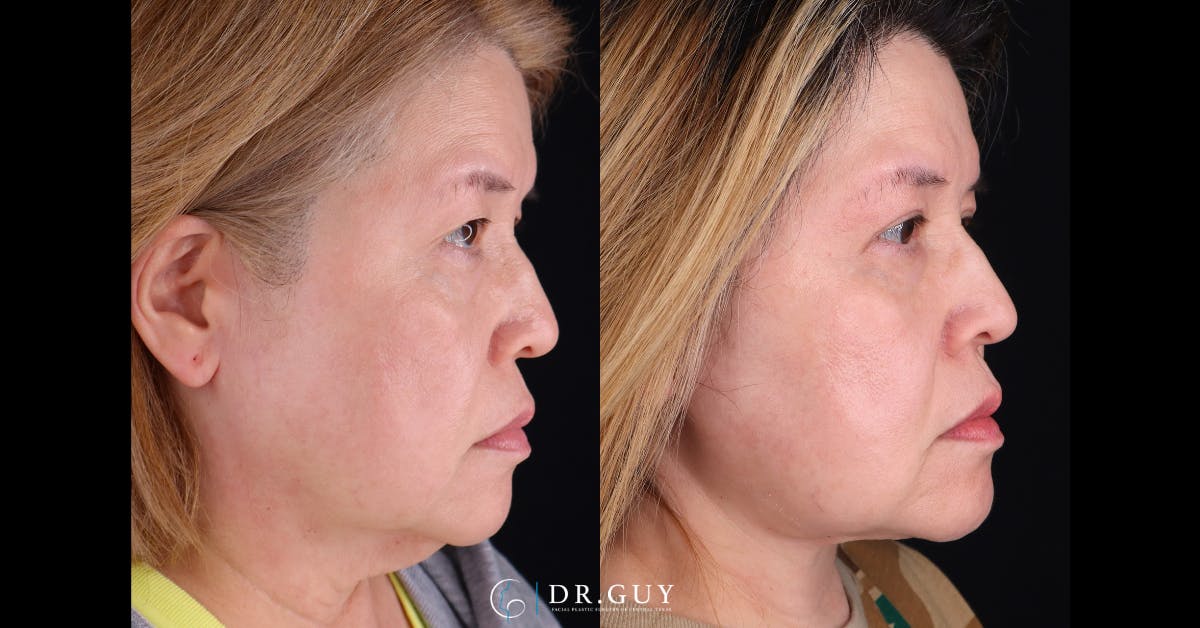 Upper Blepharoplasty Before & After Gallery - Patient 360891 - Image 5