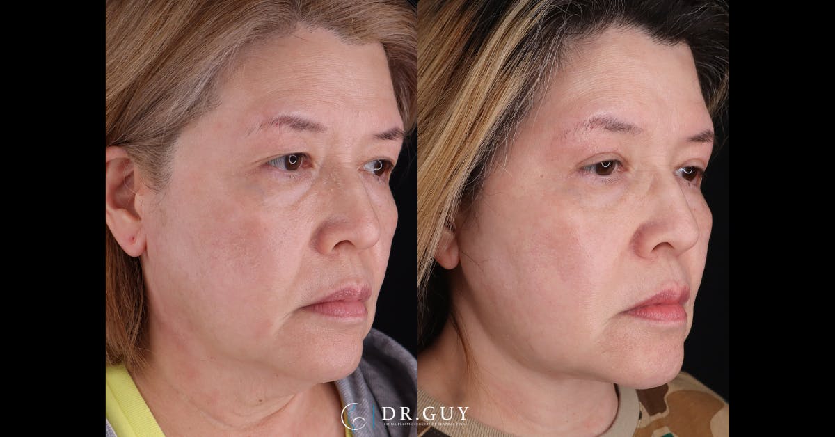 Upper Blepharoplasty Before & After Gallery - Patient 360891 - Image 4