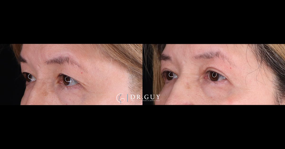 Upper Blepharoplasty Before & After Gallery - Patient 360891 - Image 1