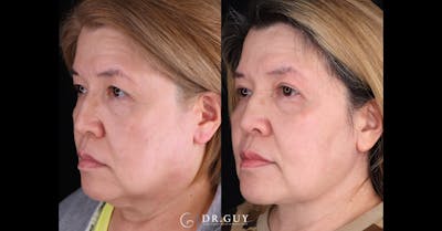 Neck Lift Before & After Gallery - Patient 276873 - Image 1
