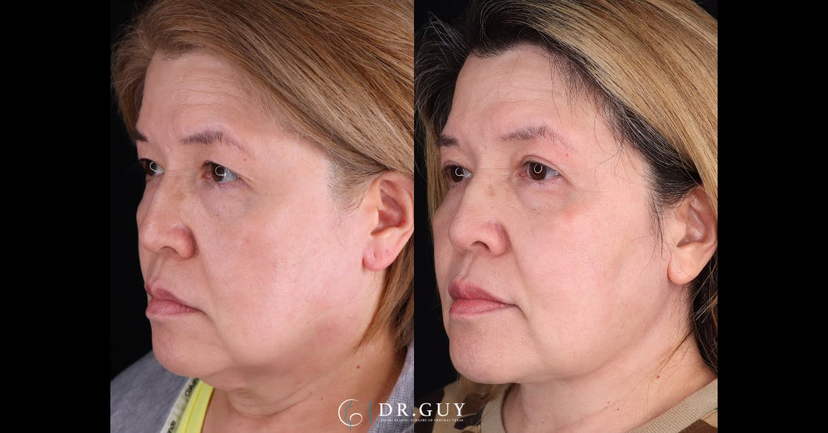 Upper Blepharoplasty Before & After Gallery - Patient 360891 - Image 2