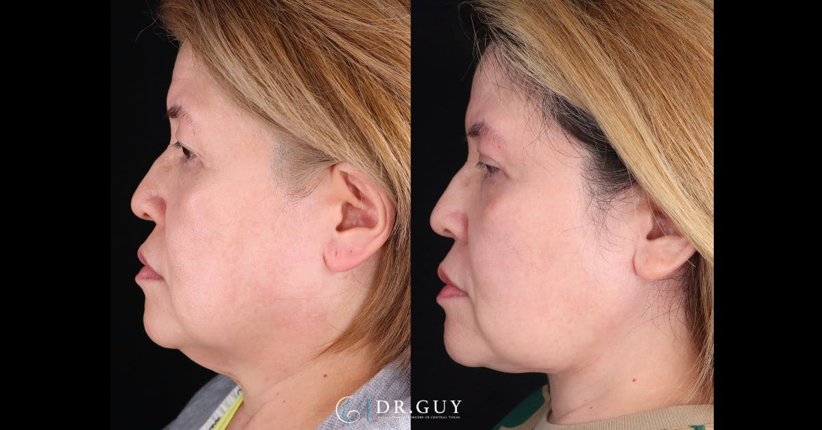 Upper Blepharoplasty Before & After Gallery - Patient 360891 - Image 3