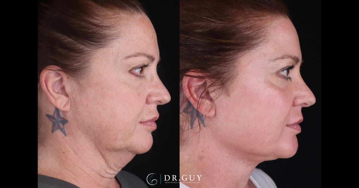 Neck Lift Before & After Gallery - Patient 276178 - Image 3
