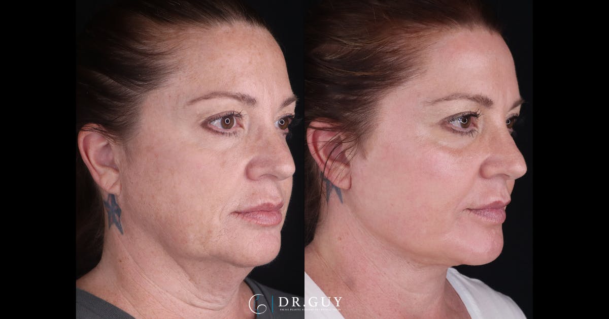 Neck Lift Before & After Gallery - Patient 276178 - Image 4