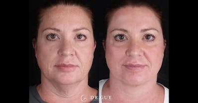 Upper Blepharoplasty Before & After Gallery - Patient 200415 - Image 1