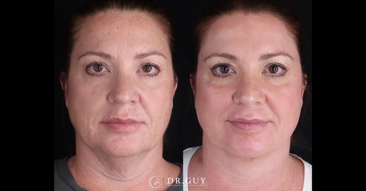Neck Lift Before & After Gallery - Patient 276178 - Image 2