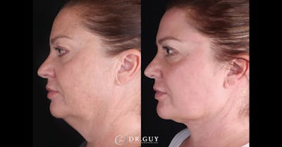 Neck Lift Before & After Gallery - Patient 276178 - Image 1