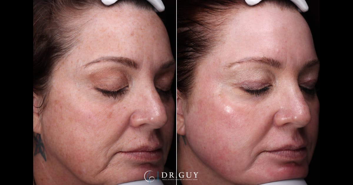 Laser Before & After Gallery - Patient 359826 - Image 3