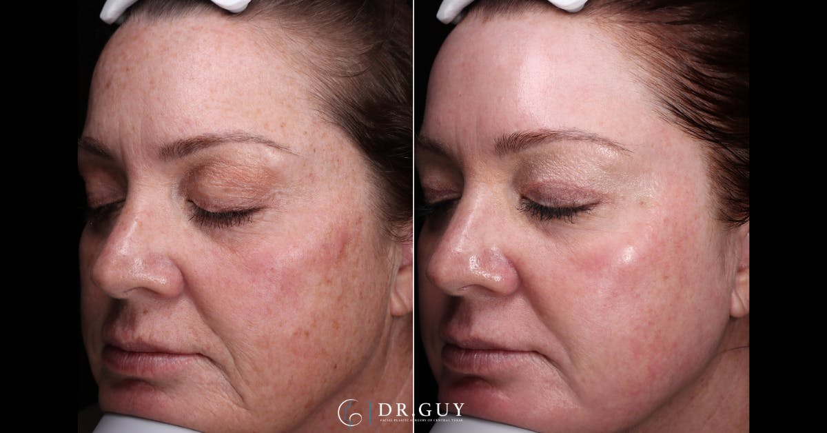 Laser Before & After Gallery - Patient 359826 - Image 2