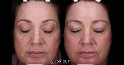 Laser Before & After Gallery - Patient 359826 - Image 1