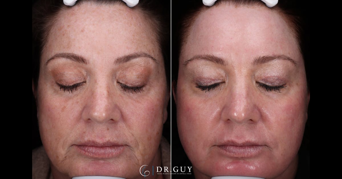 Laser Before & After Gallery - Patient 359826 - Image 1