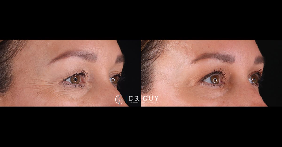 Upper Blepharoplasty Before & After Gallery - Patient 358145 - Image 3