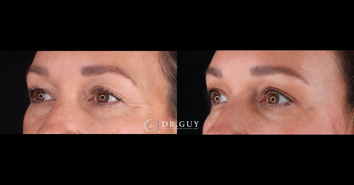 Upper Blepharoplasty Before & After Gallery - Patient 358145 - Image 4