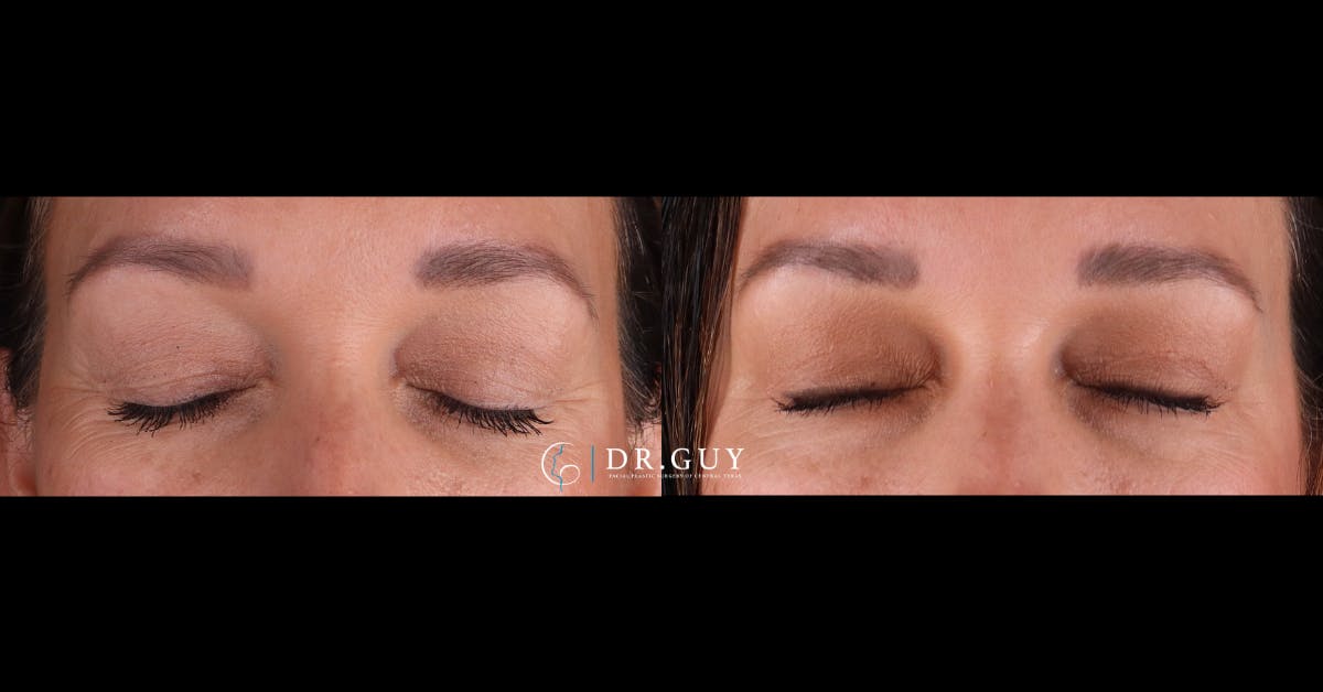 Upper Blepharoplasty Before & After Gallery - Patient 358145 - Image 2