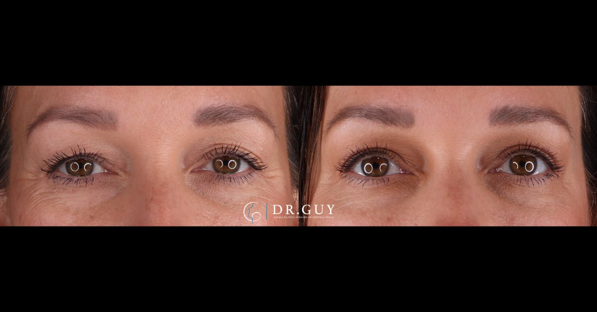 Upper Blepharoplasty Before & After Gallery - Patient 358145 - Image 1