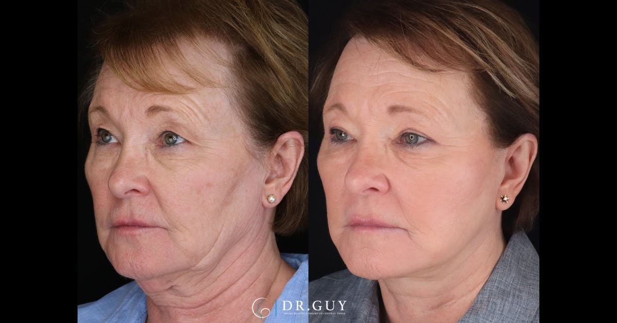 Upper Blepharoplasty Before & After Gallery - Patient 154226 - Image 3