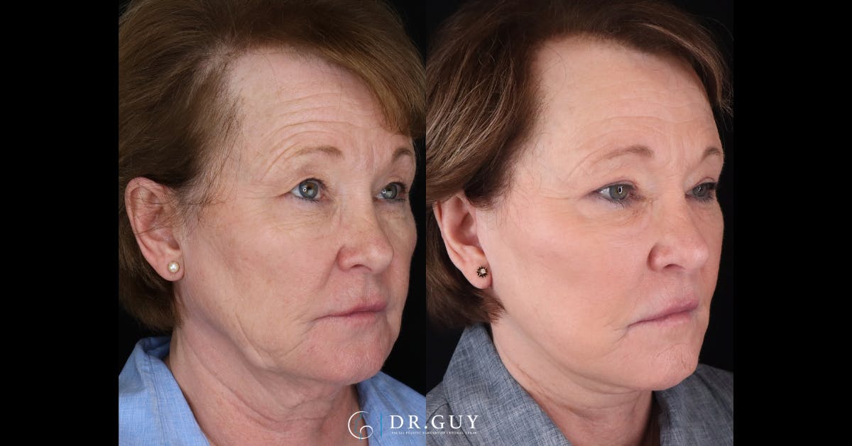 Upper Blepharoplasty Before & After Gallery - Patient 154226 - Image 2