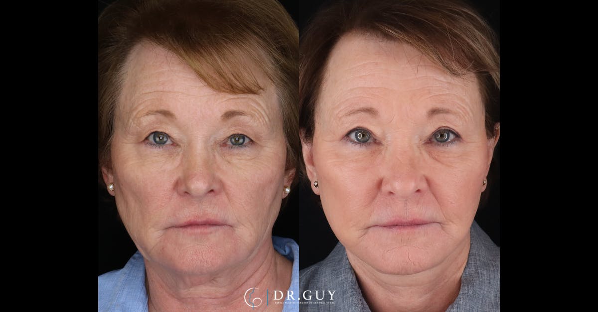 Upper Blepharoplasty Before & After Gallery - Patient 154226 - Image 1