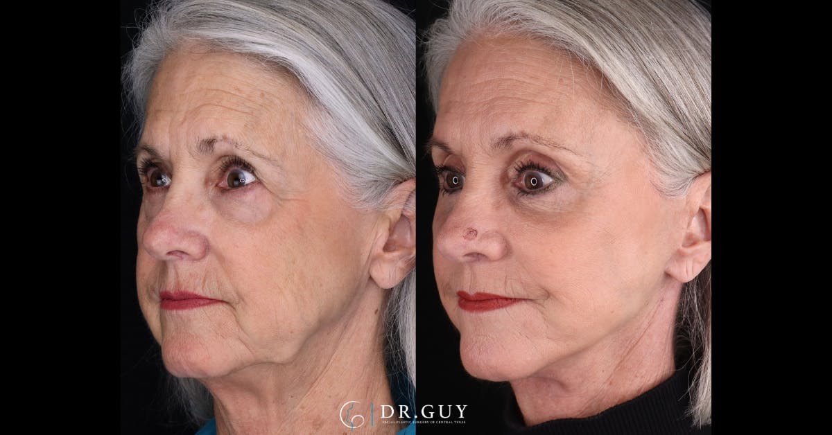 Upper Blepharoplasty Before & After Gallery - Patient 355064 - Image 4