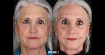 Upper Blepharoplasty Before & After Gallery - Patient 355064 - Image 1