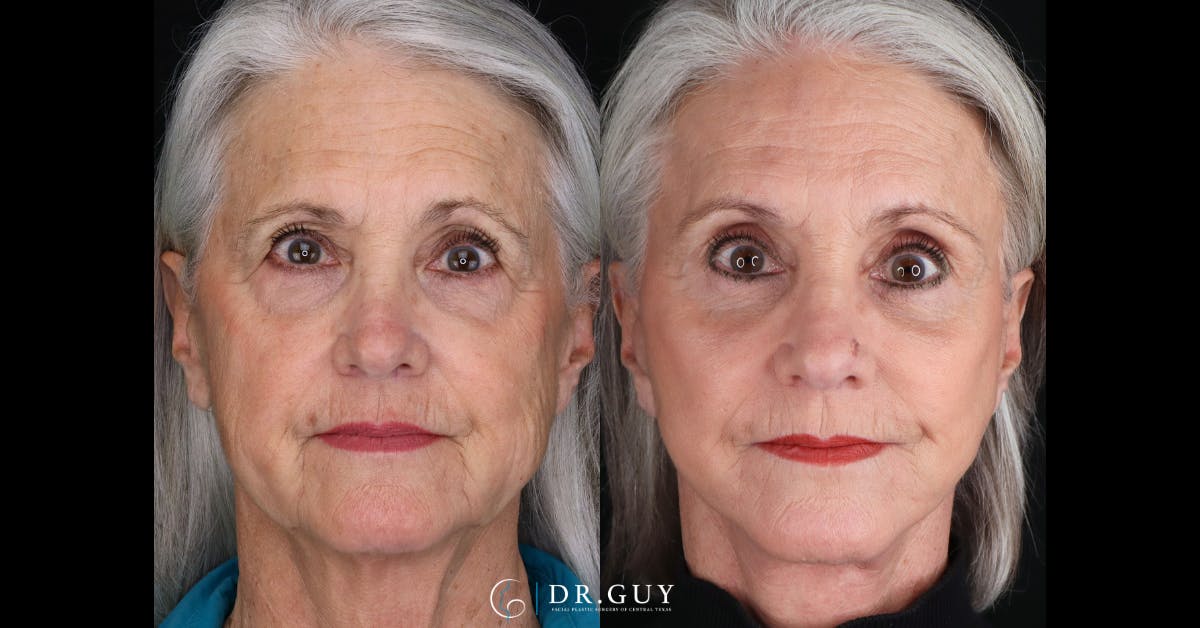 Upper Blepharoplasty Before & After Gallery - Patient 355064 - Image 1