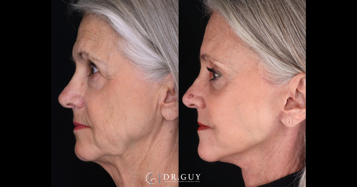 Upper Blepharoplasty Before & After Gallery - Patient 355064 - Image 5