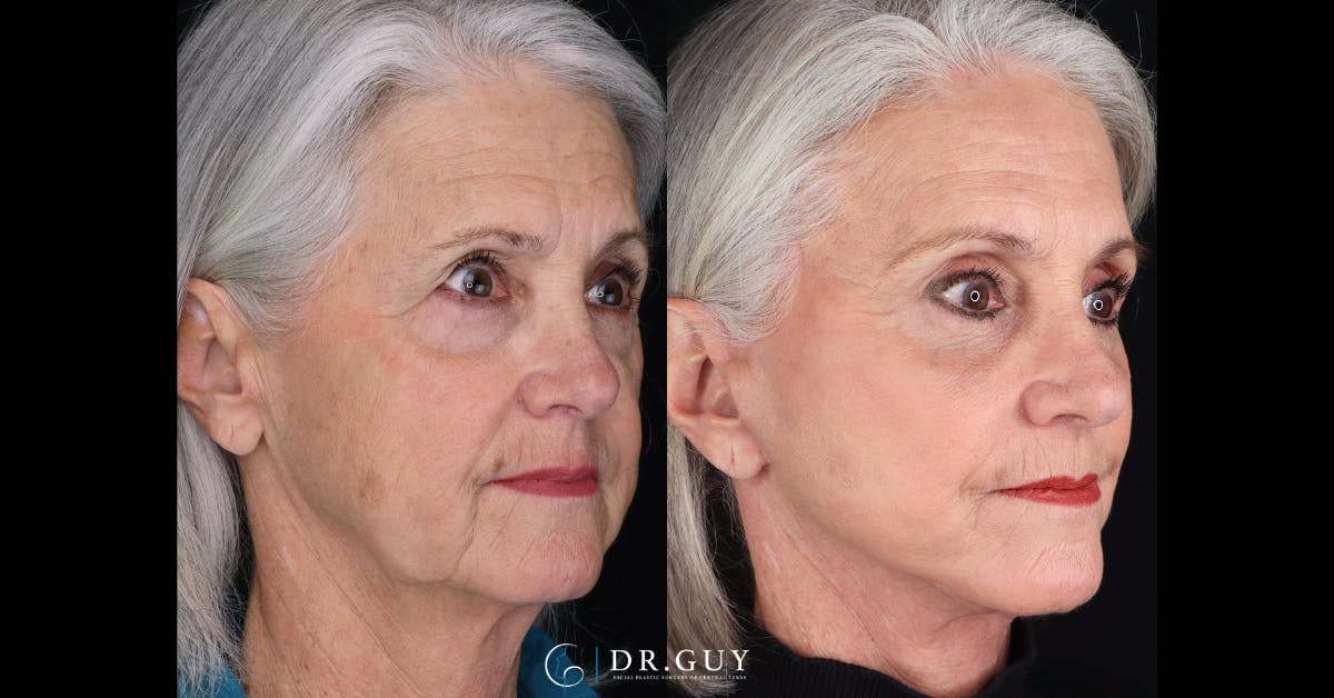 Upper Blepharoplasty Before & After Gallery - Patient 355064 - Image 2