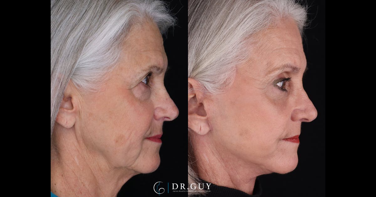 Upper Blepharoplasty Before & After Gallery - Patient 355064 - Image 3