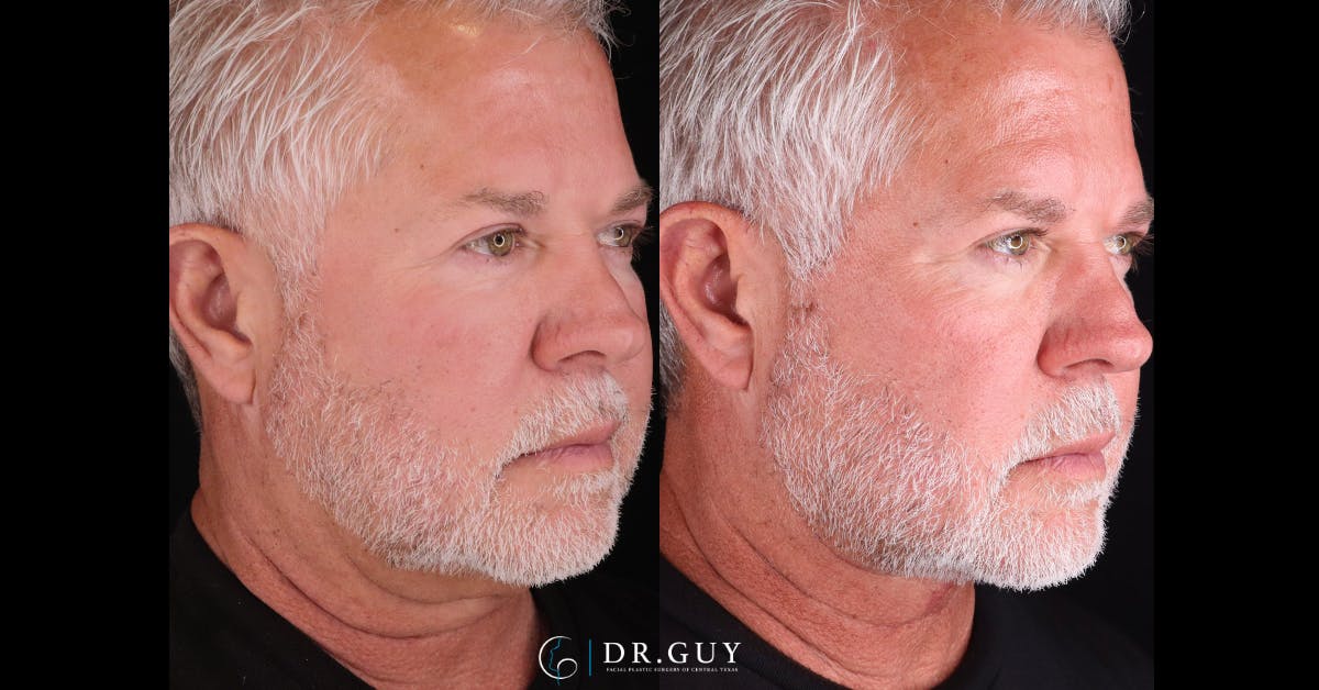 Neck Lift Before & After Gallery - Patient 790874 - Image 3