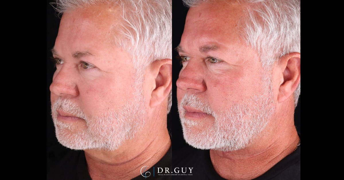Neck Lift Before & After Gallery - Patient 790874 - Image 2