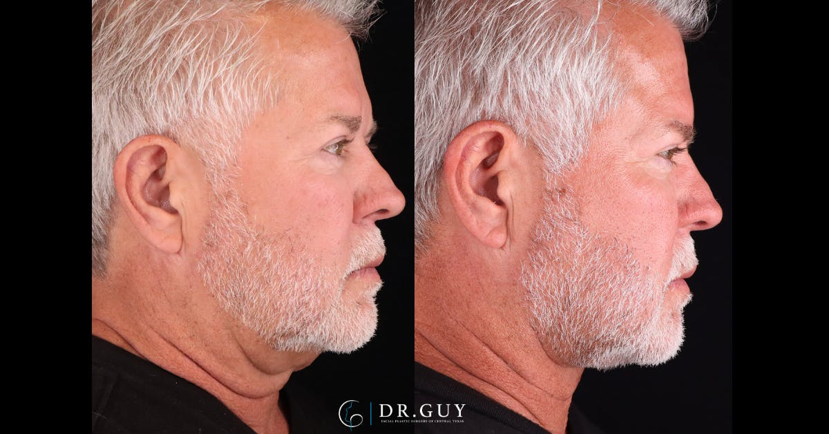 Neck Lift Before & After Gallery - Patient 790874 - Image 4