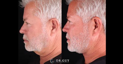 Neck Lift Before & After Gallery - Patient 790874 - Image 1