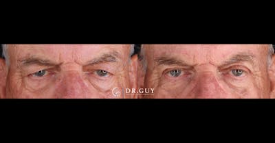 Upper Blepharoplasty Before & After Gallery - Patient 363724 - Image 1