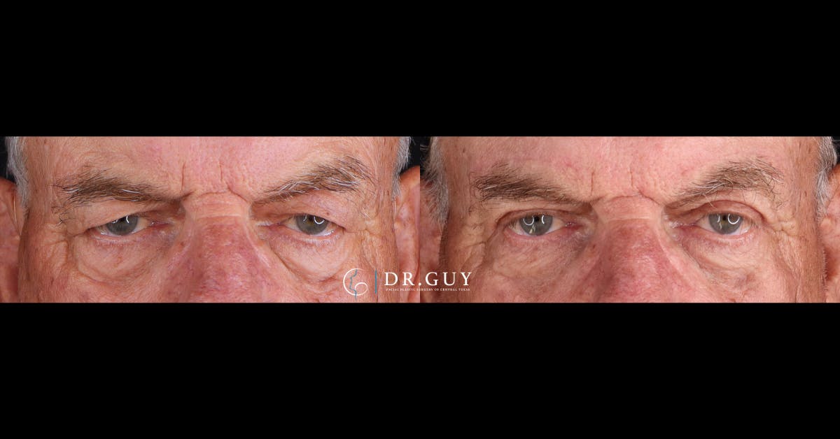 Upper Blepharoplasty Before & After Gallery - Patient 363724 - Image 1