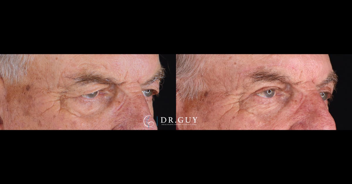Upper Blepharoplasty Before & After Gallery - Patient 363724 - Image 2