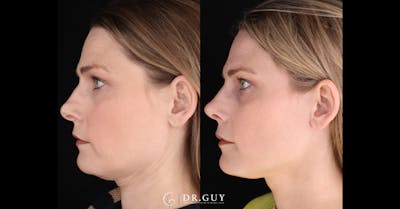 Neck Lift Before & After Gallery - Patient 272802 - Image 1