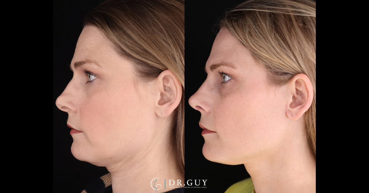 Surgical Rhinoplasty Before & After Gallery - Patient 404277 - Image 2