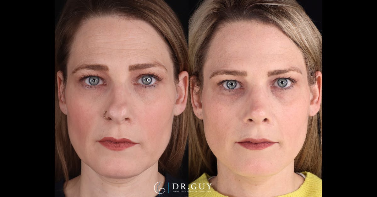 Surgical Rhinoplasty Before & After Gallery - Patient 404277 - Image 3