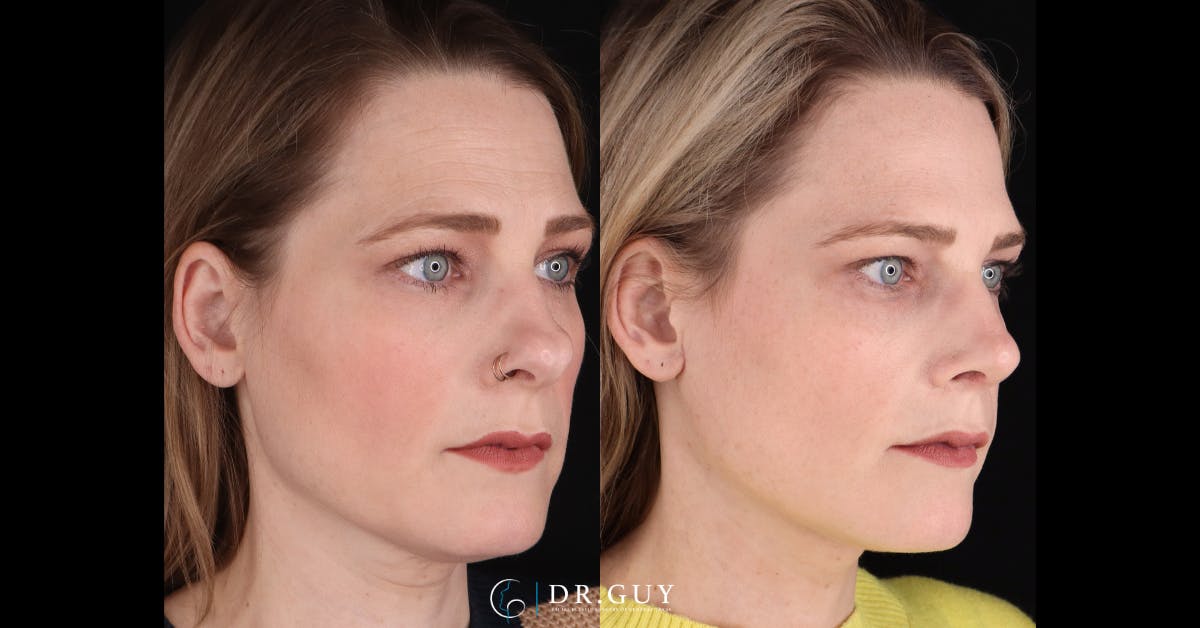 Surgical Rhinoplasty Before & After Gallery - Patient 404277 - Image 4
