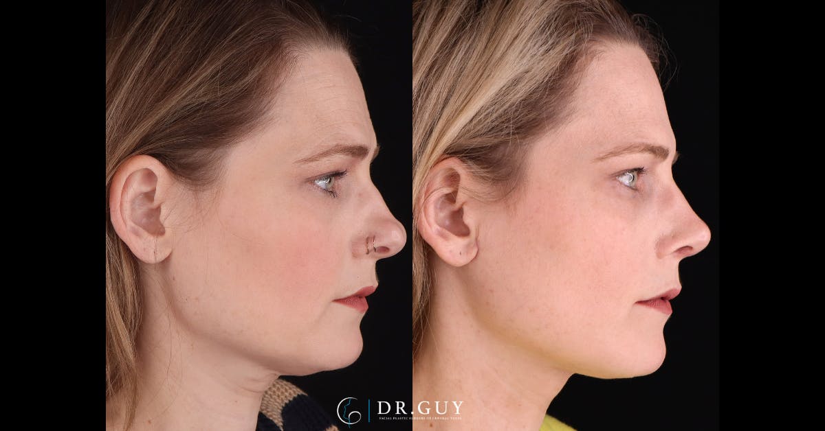Surgical Rhinoplasty Before & After Gallery - Patient 404277 - Image 5