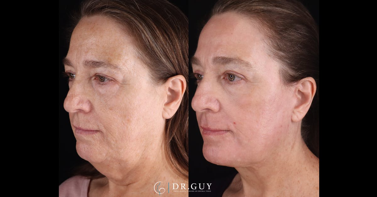 Lower Blepharoplasty Before & After Gallery - Patient 233556 - Image 4