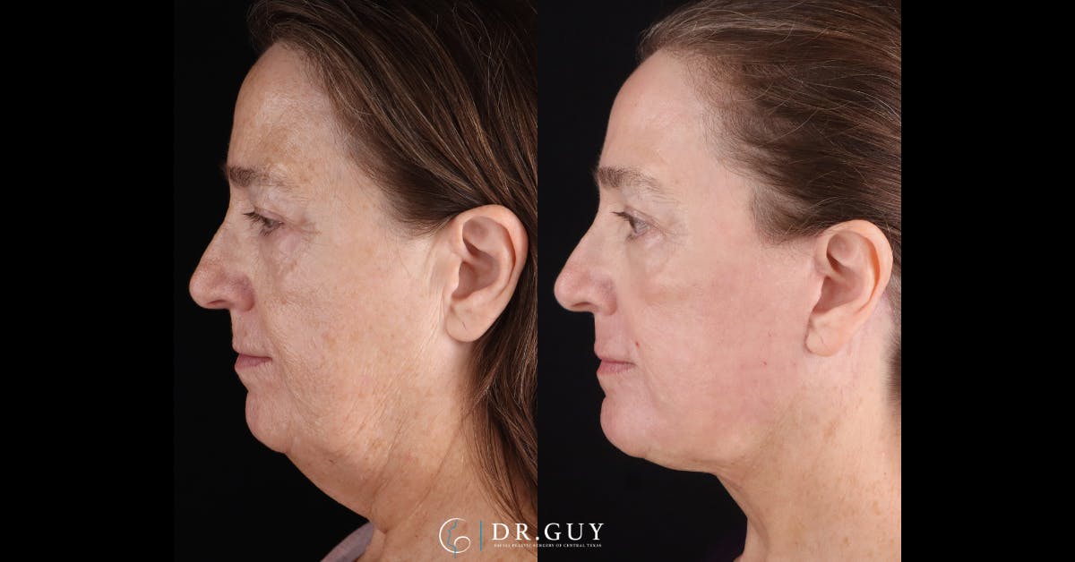 Lower Blepharoplasty Before & After Gallery - Patient 233556 - Image 5