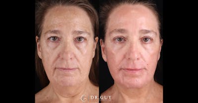 Laser Before & After Gallery - Patient 390950 - Image 1