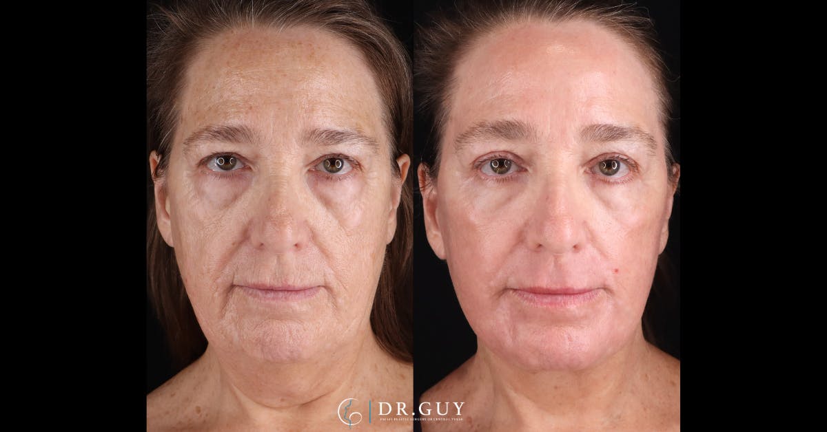 Lower Blepharoplasty Before & After Gallery - Patient 233556 - Image 1