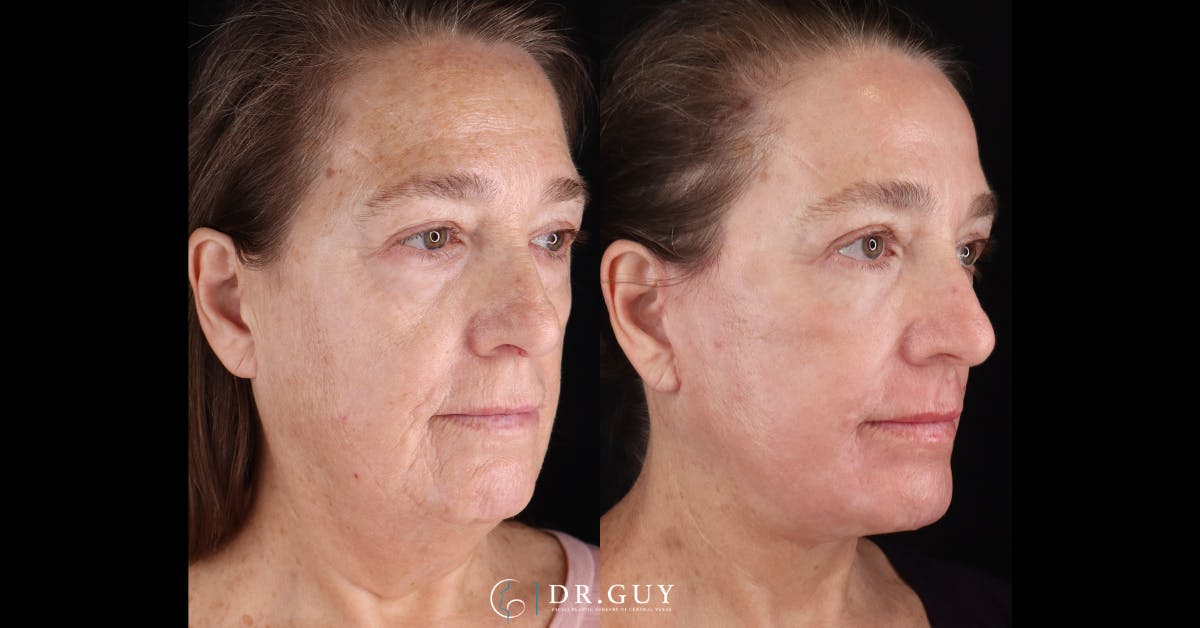 Lower Blepharoplasty Before & After Gallery - Patient 233556 - Image 2
