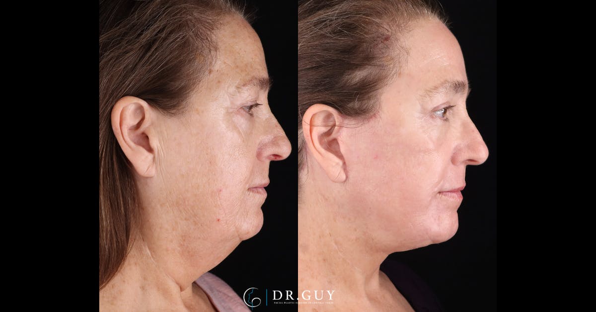 Lower Blepharoplasty Before & After Gallery - Patient 233556 - Image 3