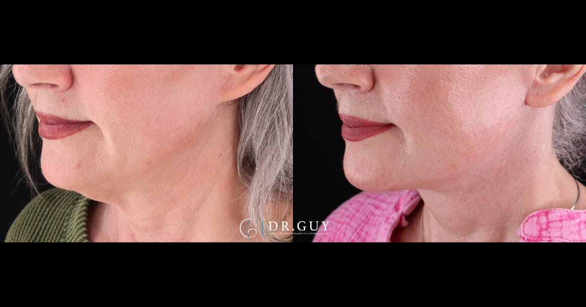 Neck Lift Before & After Gallery - Patient 420505 - Image 2