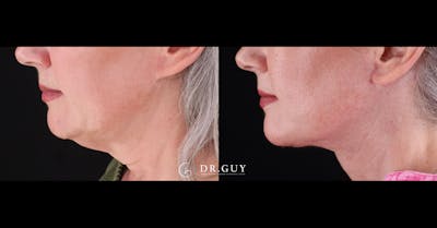 Neck Lift Before & After Gallery - Patient 420505 - Image 1
