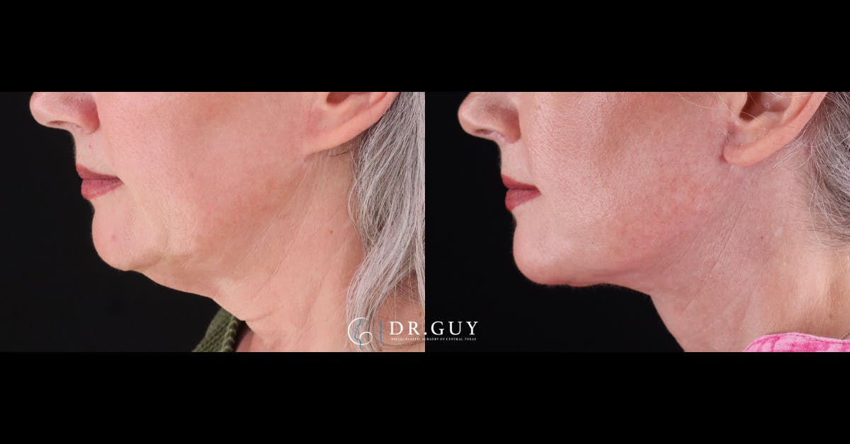 Neck Lift Before & After Gallery - Patient 420505 - Image 1