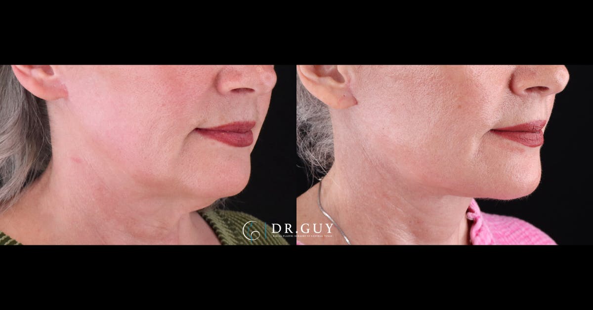 Neck Lift Before & After Gallery - Patient 420505 - Image 3